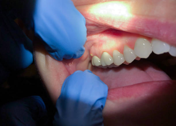 Best Knocked-Out Tooth Emergency  in Bowdon, GA